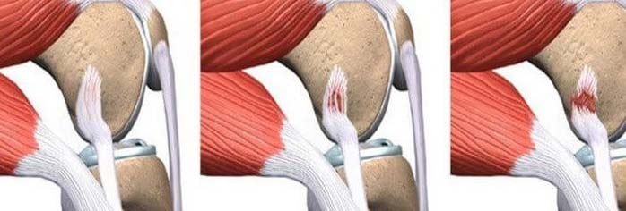 Повреждение связок колена